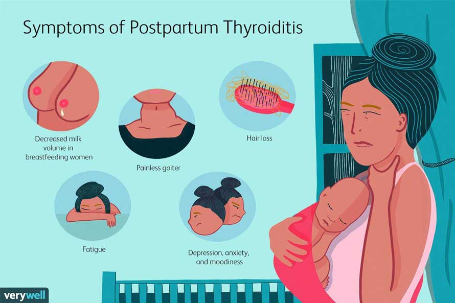 Triệu chứng của viêm giáp sau sinh 