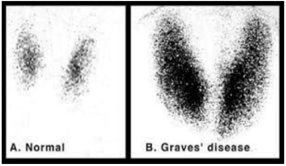 Xạ hình tuyến giáp bình thường và ở người bệnh Graves