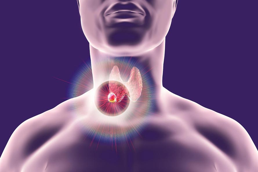 Cabozantinib Appears to be a Promising New Treatment Option in  Radioiodine-Refractory Differentiated Thyroid Cancer