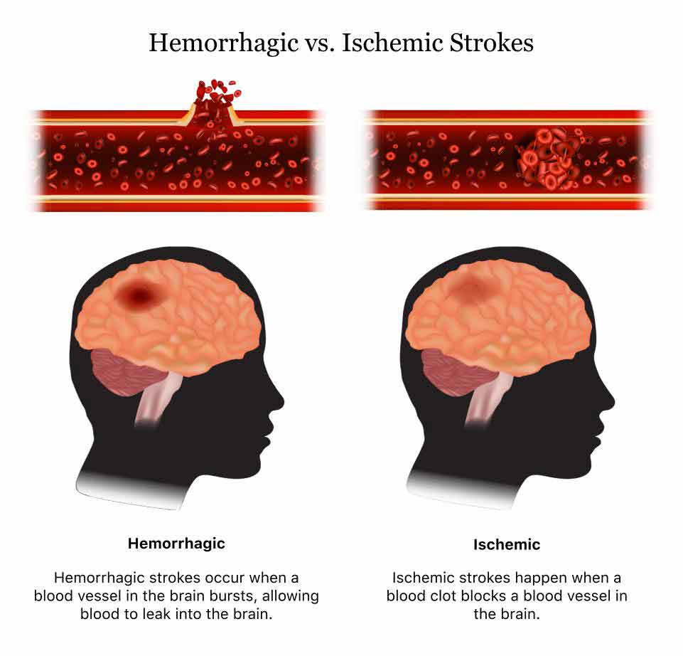 Stroke | Symptoms, Causes and Stroke Prevention