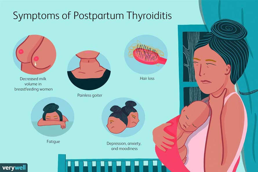 Postpartum Thyroiditis and Related Issues After Pregnancy