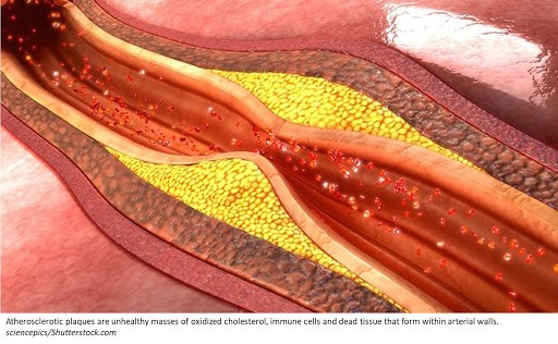 Mảng xơ vữa động mạch do lipid làm hẹp lòng mạch máu 