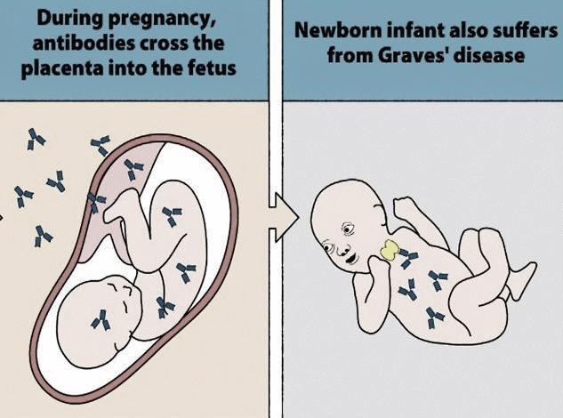 Cường giáp sơ sinh do bệnh Graves ở mẹ không điều trị