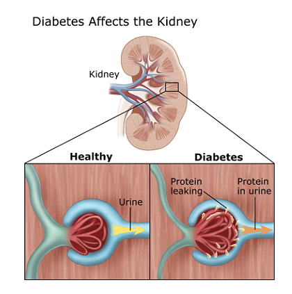 Nephron thận ở người bình thường và người đái tháo đường